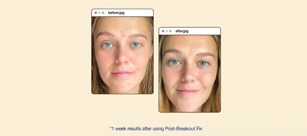 Dermalogica Post-Breakout Fix 15 ml - Slika 3